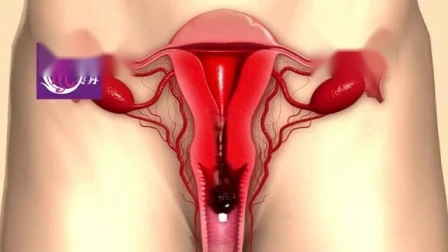 자궁 디톡스 질 클린 포인트 탐폰 여성 위생용품